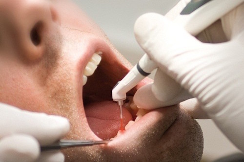 Имплантация зубов: что это такое?
