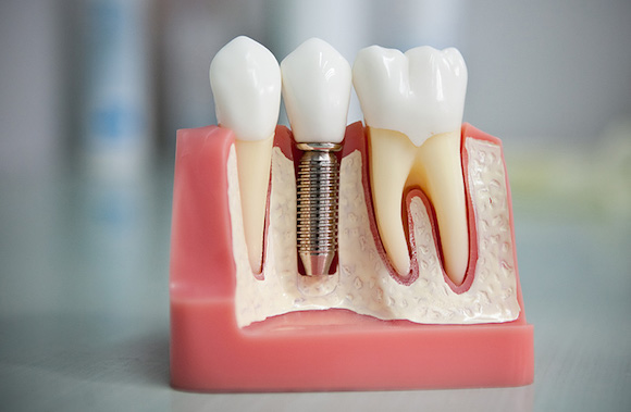Имплантация зубов: как выбрать клинику