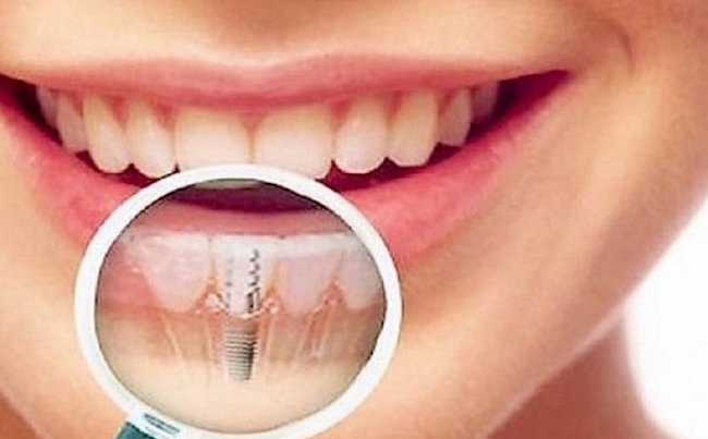 Имплантация зубов в стоматологии DDclinic
