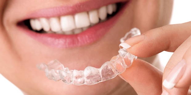 Элайнеры для выравнивания зубов – прозрачная альтернатива брекетам