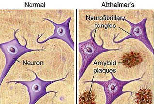 Неужели лечение болезни Альцгеймера возможно?