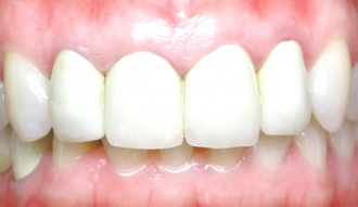 Имплантация зубов: все за и против