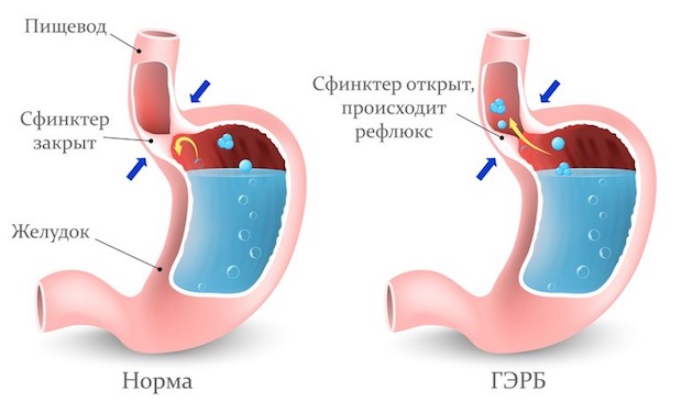 Гастроэзофагеальный рефлюкс: лечить обязательно!