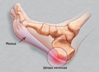 Пяточная шпора