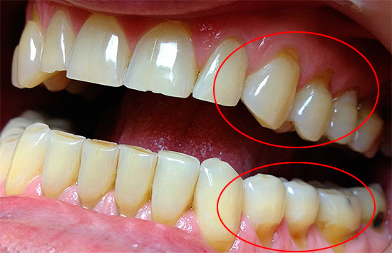 Способы лечения и профилактика клиновидного дефекта зубов